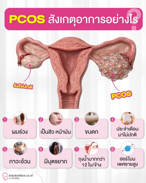 ปล่อยมานานไม่ท้องสักที เช็คด่วน! 8 สัญญาณเตือนภาวะ PCOS ถุงน้ำในรังไข่หลายใบ ไข่ไม่ตก ท้องยาก!