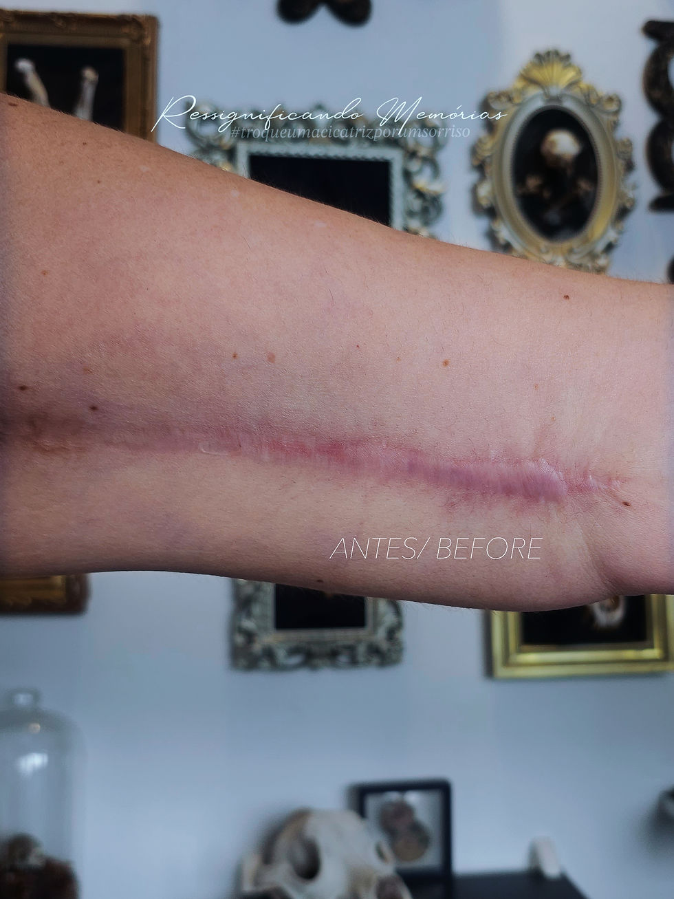Cicatriz causada por cirurgia de braquioplastia com apresentação hipertrófica e áreas de aderência. Foto acervo particular profissional Elvira Bono