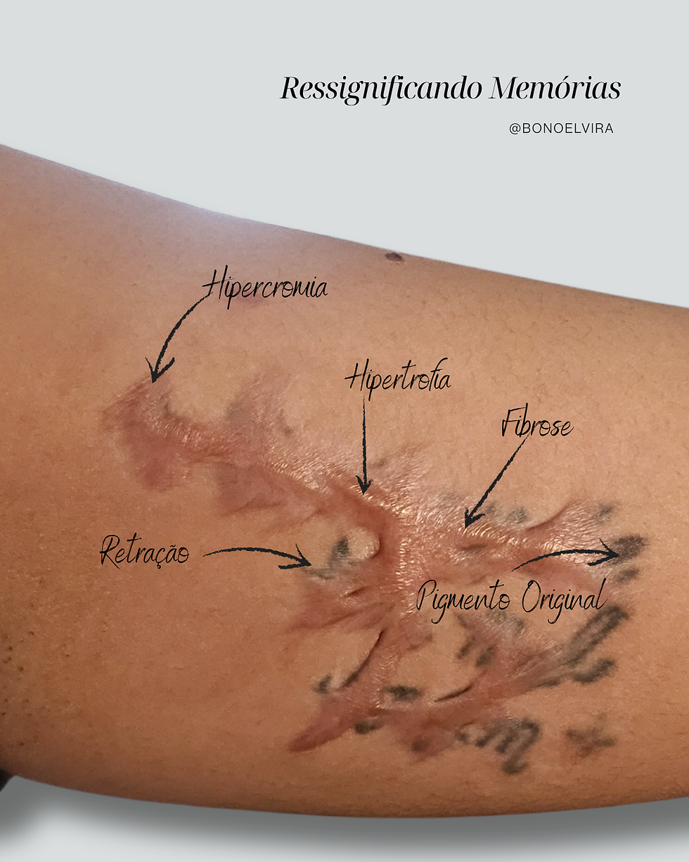 Cicatriz na região interna do braço, adquirida após tentativa de remoção a laser de uma tatuagem. A cicatriz apresenta aspectos de hipercromia, hipertrofia, fibrose, retração e resíduo do pigmento original em várias áreas. Imagem de acervo pessoal, profissional Elvira Bono.