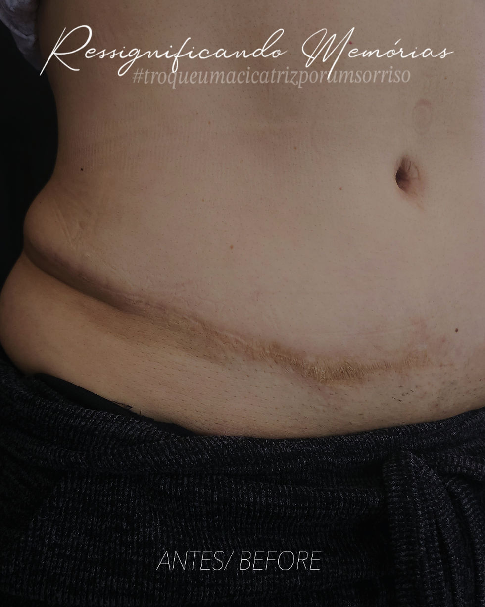 Cicatriz, causada por cirurgia de abdominoplastia, com apresentação irregular e aspecto de "alça" residual de gordura nos flancos. Foto acervo particular profissional Elvira Bono
