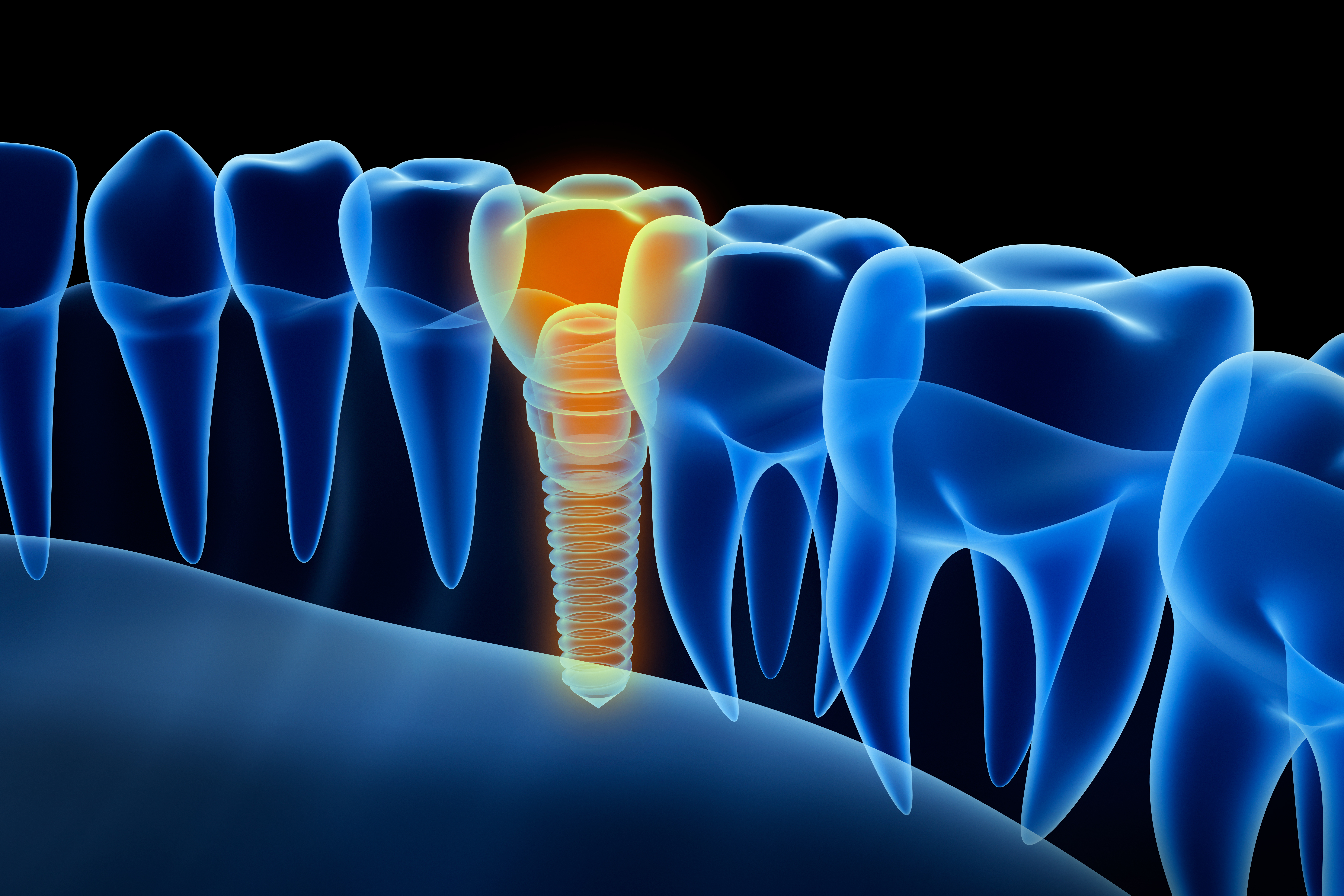 dental-implant-illustration-3d.jpg