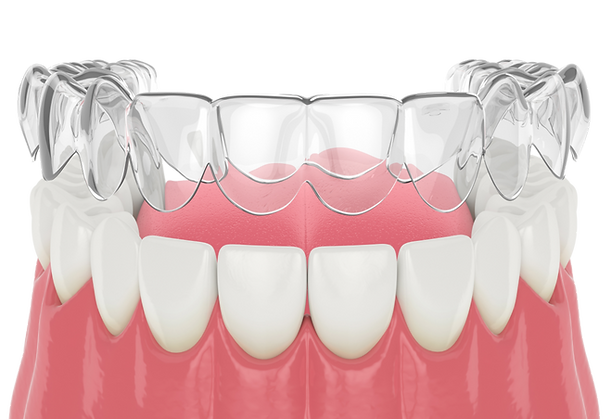 Clear aligner over teeth