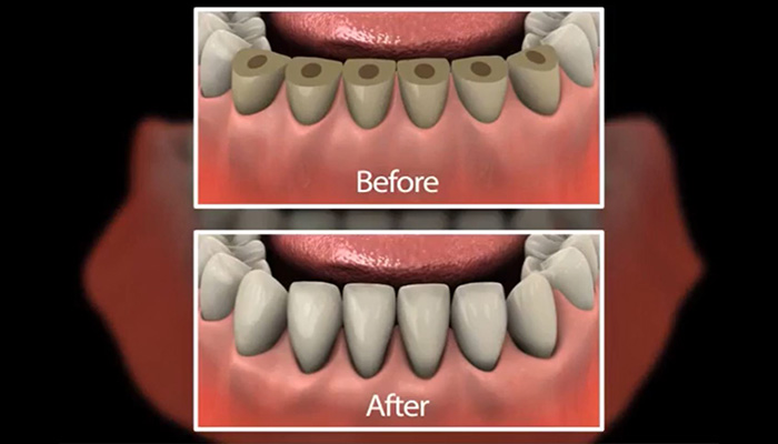 esthestic_crown_lengthening_002.jpg