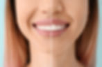 Top-rated cosmetic dentist can change the shape and size of your teeth with cosmetic contouring