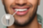 close up of man with natural looking dental implant showing benefits of seeing Ballard dentist near you, Dr. Emmaleigh Gordon