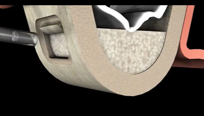bone_and_sinus_grafting_002.jpg