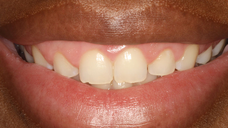 crown_lengthening_before.jpeg