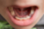boy with open mouth showing metal space maintainers on teeth