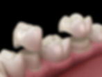 illustration of dental crowns at The Center for Adult Dentistry, dental office in Temecula and La Quinta