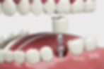 illustration of a single dental implant, abutment and crown, effective tooth replacement solutions at Hygge Laser Dentistry, dental office providing pain-free, permanent dental implants in Ballard