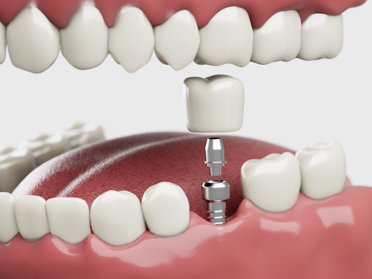 Ballard Neighborhood Dentist