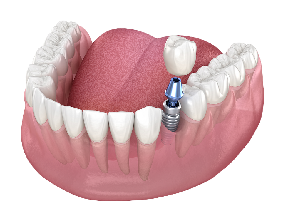 shutterstock_implant pylant 1780338602.jpg