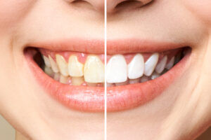 Ready For Professional Teeth Whitening?