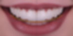 Before-and-after results of a smile makeover performed by Dr. Michael Spitzer in Costa Mesa, CA, creating a natural, beautiful smile.