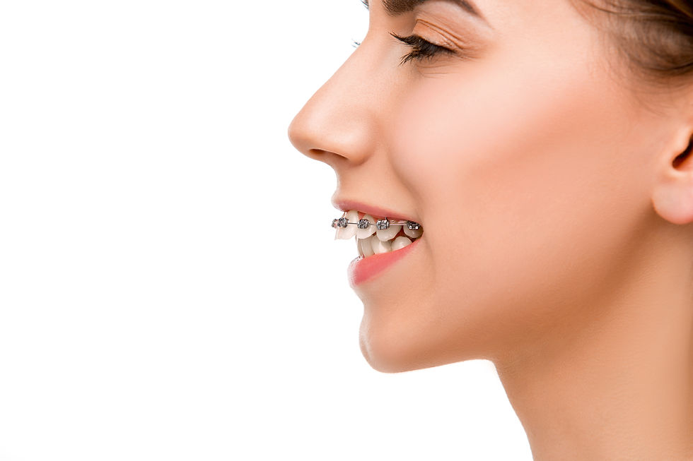 side view of teenage girl with large overbite wearing braces