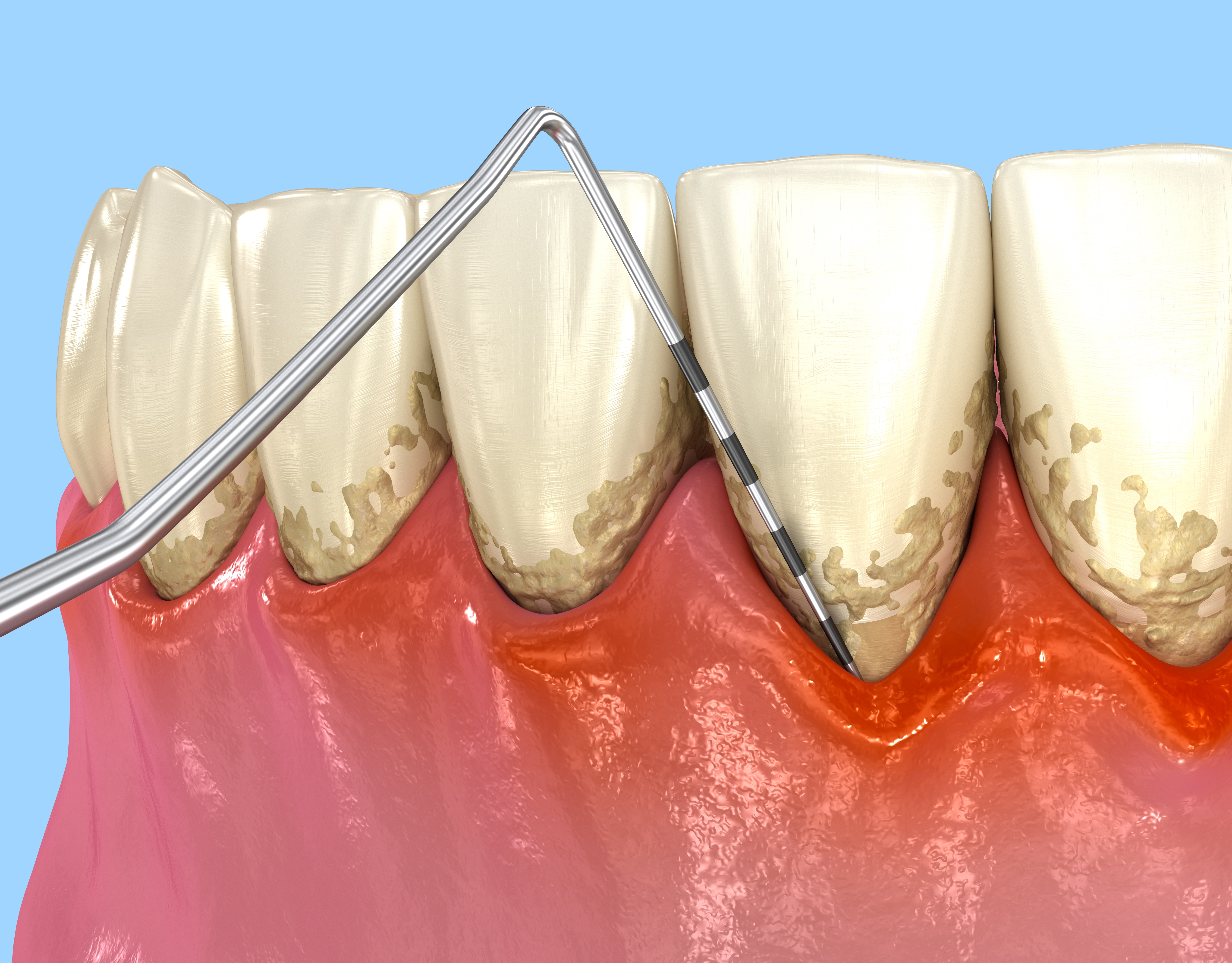 periodontal-probe-illustration.jpg