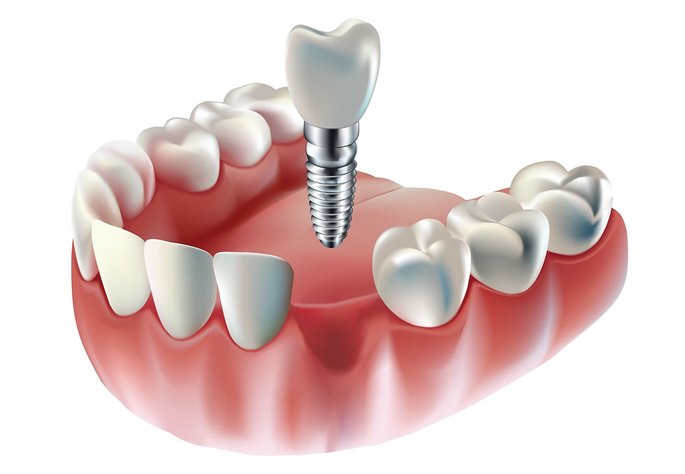 dental implant
