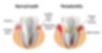 illustration showing healthy tooth vs tooth with periodontitis, which is treatable at Temecula dental office of Dr. Dave Cutt