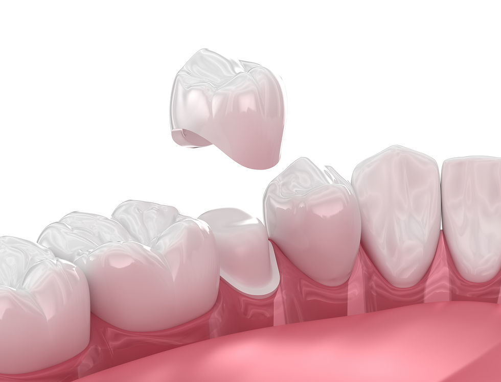 dental crown illustration