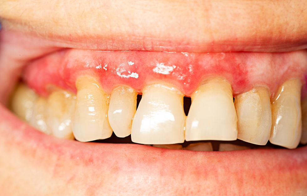close of up teeth showing calculus and inflamed red gums which are signs of gum disease