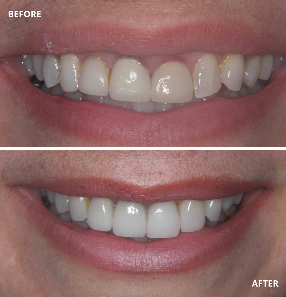 Smile transformation from misshapen, discolored teeth to a bright, white smile by Dr. Michael Spitzer