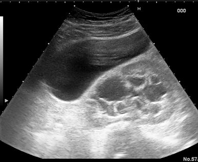 adenoma-22_edited.jpg