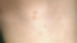 Molusco contagioso