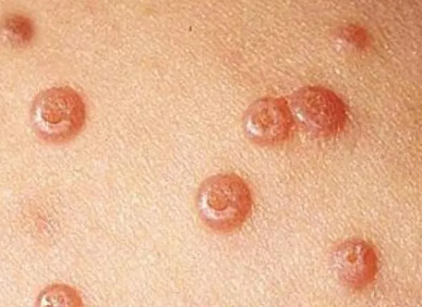 Que es un papiloma en el pecho - Que es papiloma de seno Que es papiloma en el pecho