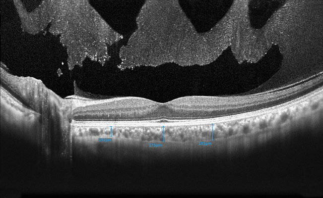 OCT-Retina5.png
