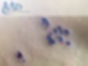 Herpes Zoster