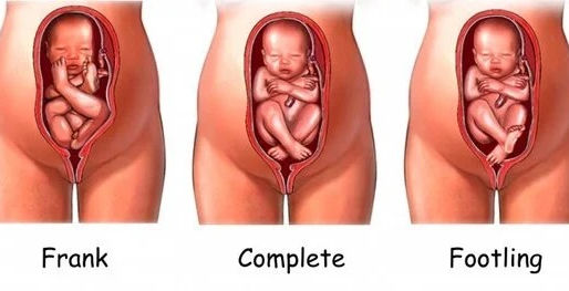 Cuando el bebé está posicionado de nalgas