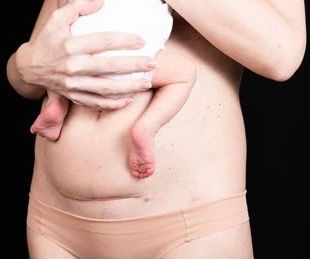 Las células fetales pueden ayudar a curar las cicatrices de la cesárea