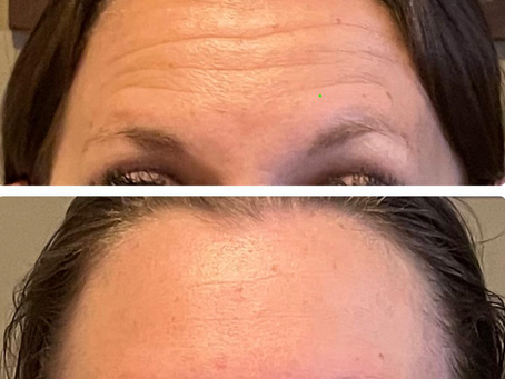 3 reasons for forehead wrinkles that Botox cannot fix
