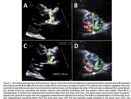 MEDICIÓN PRECISA DEL DIÁMETRO DEL TRACTO DE SALIDA DEL VENTRICULO IZQUIERDO