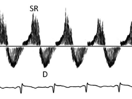 DOPPLER DE VENAS HEPÁTICAS EN INSUFICIENCIA TRICUSPIDEA.