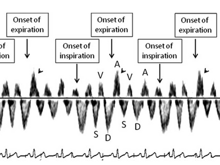 Cambios hemodinámicos asociados a la respiración en flujo de venas hepáticas. Patrón normal