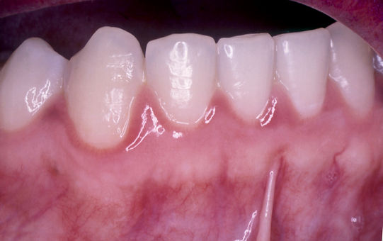 Gingivitis VIH