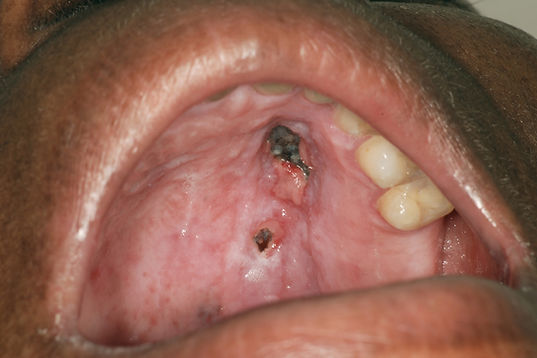 Sialometaplasia-VIH_3.JPG