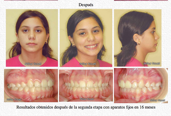 Distoclusión con mordida profunda