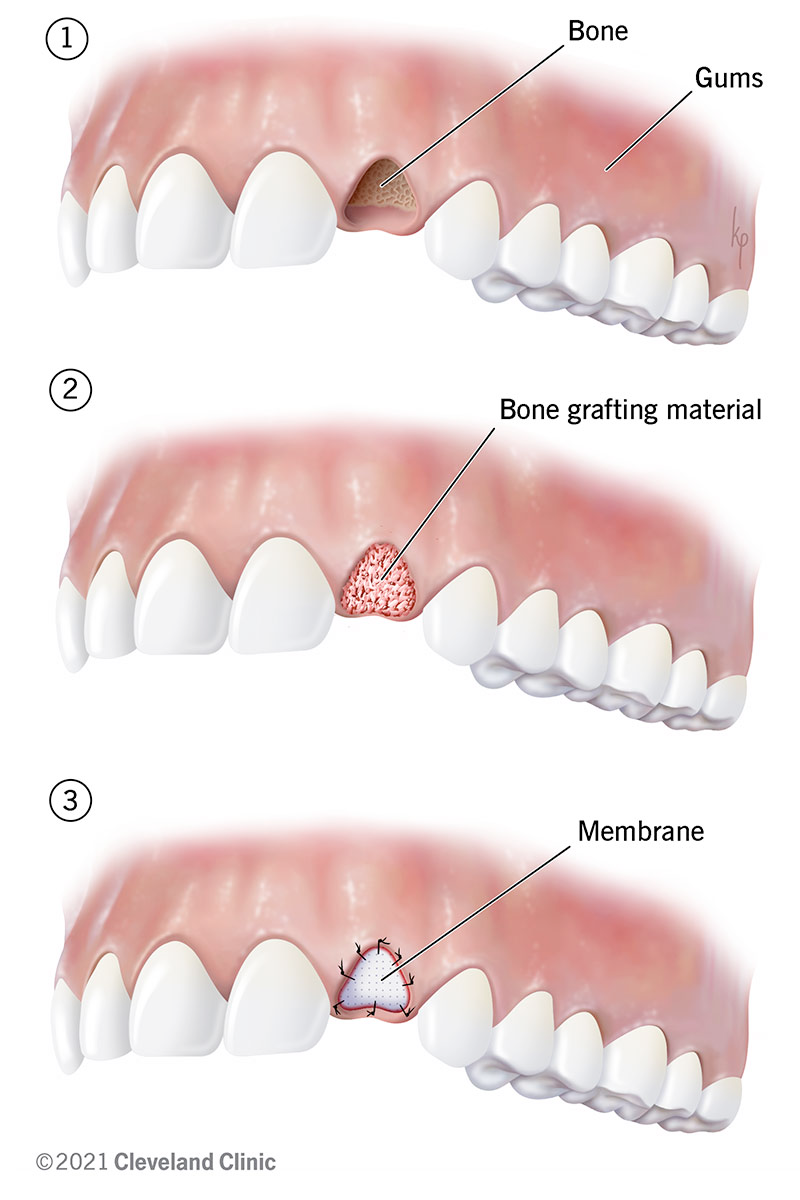 Knochenaufbau vor Implantaten – Wann ist er notwendig und wie sicher ist er?