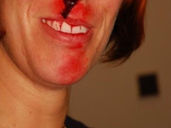 Mýtus 64 — Při krvácení z nosu zakloníme hlavu a chladíme čelo a zátylek