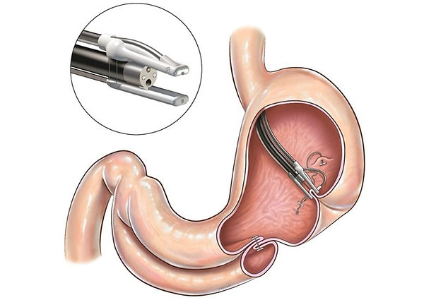 Smanjenje želuca endoskopskom sleeve gastroplastikom ESG