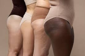 Cellulite: non è solo un inestetismo fastidioso ma un segnale del corpo