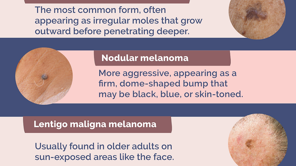 Four Types of Melanoma