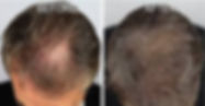Tacoma eyelash extensions,microblading,skincare,hair,novalash, waxing, permanent cosmetics, eyeliner, microblading, training, education, skin, skincare, wrinkles, age, young, youthful, acne, chemical peels, chemical peel, microblading, microneedling, microdermabrasion, look younger, best, tacoma eyelash extension training, carecredit, care credit, skin treatments, facial, facials, amazing, new, advanced, radiant, glowing, special, good, favorite, PCA, professional, corrective, dermatology, dermatologist, success, successful, anti-aging, antiaging, discoloration, highper pigmentation, sensitive, rosacia, rosacea, redness, retinol, dermaplaining, microdemaplaning, dermaplaning, men, women, teen, bighter