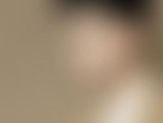 FUE Hair Transplant Singapore – The Natural Solution for Hair Loss