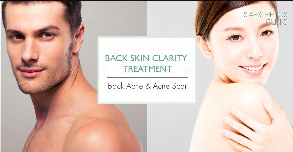 back acne treatment