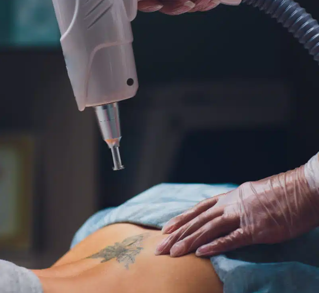 tattoo removal Singapore