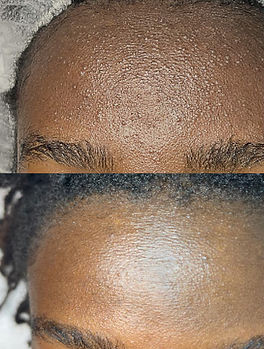 Avant et après d'un soins Thesera G : une peau bosselée, puis une peau saine et lisse