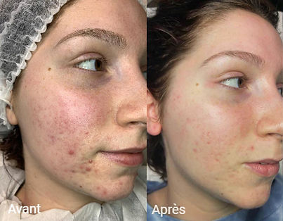 Avant après Thesera G : une peau pleine de boutons, puis une peau plus saine, avec beaucoup moins de boutons.